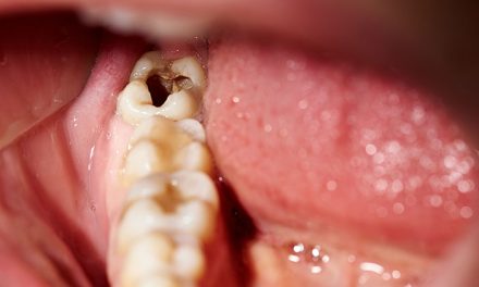 Gigi Berlubang Tapi Tidak Sakit, Apakah Berbahaya?