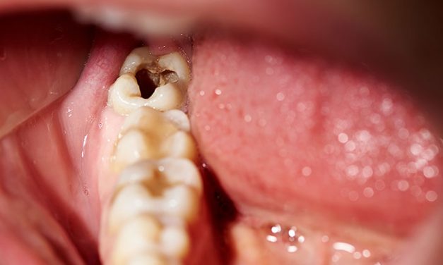 Gigi Berlubang Tapi Tidak Sakit, Apakah Berbahaya?