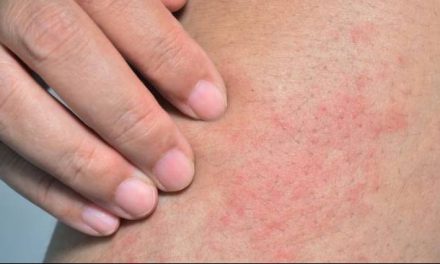 Cara Mencegah Penyakit Kulit Akibat Cuaca Panas Dan Lembap