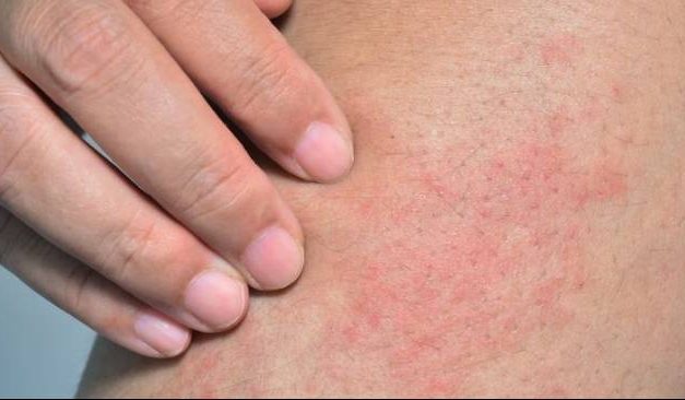 Cara Mencegah Penyakit Kulit Akibat Cuaca Panas Dan Lembap