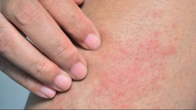 Cara Mencegah Penyakit Kulit Akibat Cuaca Panas Dan Lembap