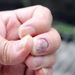 Kuku Berjamur: Penyebab, Gejala, Dan Cara Jaga Kesehatan Kuku