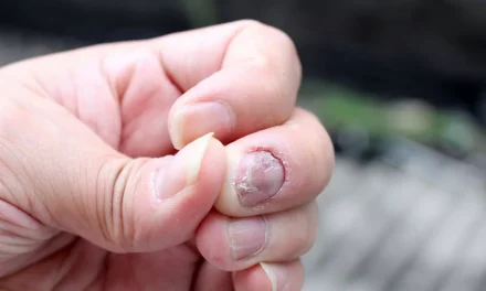 Kuku Berjamur: Penyebab, Gejala, Dan Cara Jaga Kesehatan Kuku